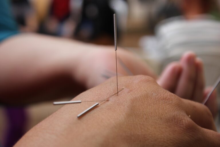 Detalle de una sesión de acupuntura